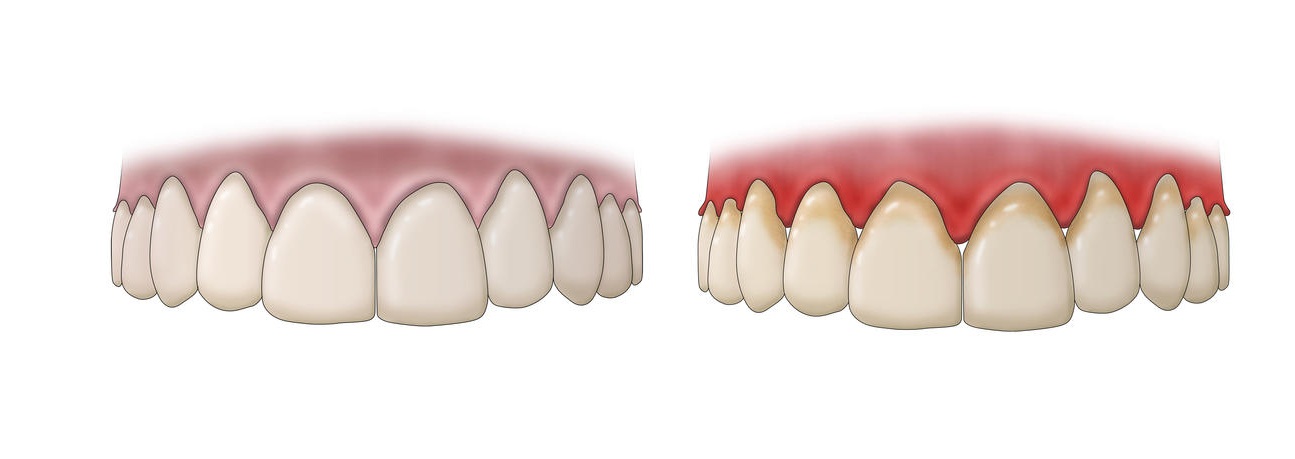 Гингивит